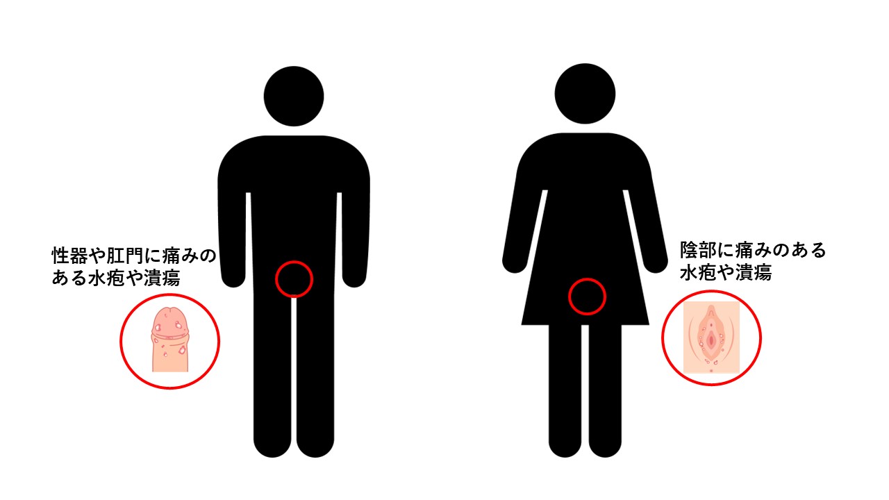 性器ヘルペスウイルス症状
