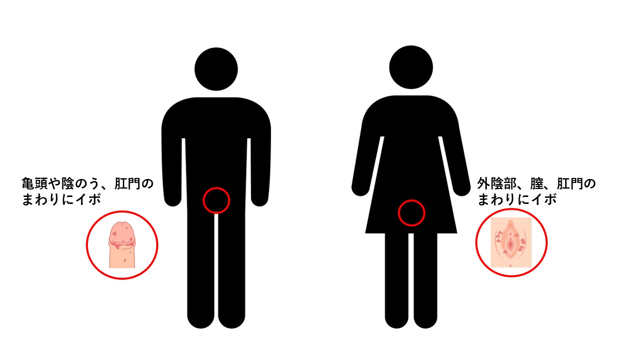 尖圭コンジローマ症状