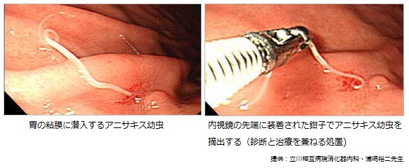 胃の粘膜に潜入するアニサキス幼虫