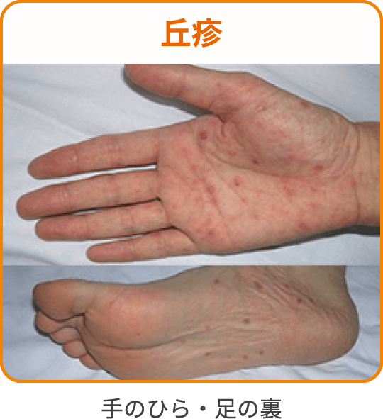 症例画像(丘疹)