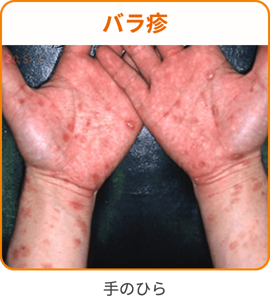 症例画像(バラ疹)