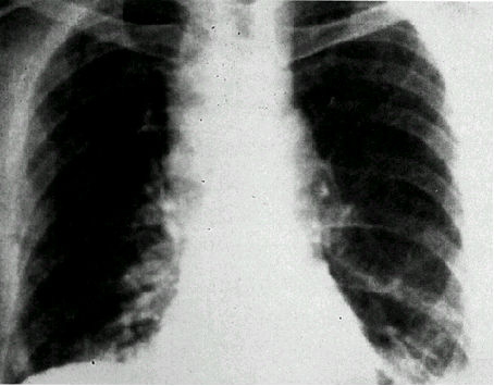 炭疽菌に感染した51歳男性の胸部レントゲン写真