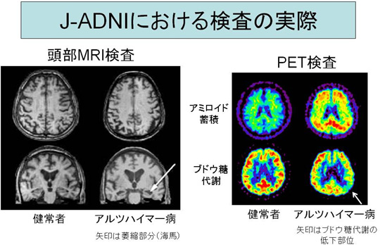 J-ADNIɂ錟̎