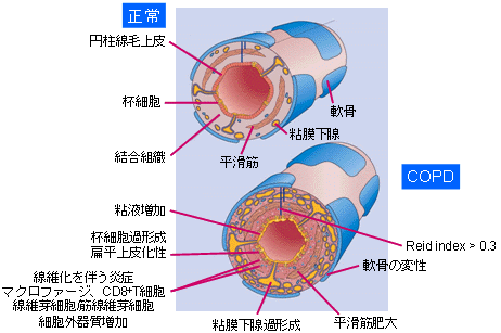 CF vs COPD̐}