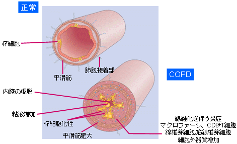 ׂCF vs COPD̐}