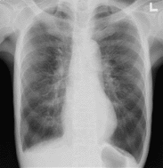 COPDの肺レントゲン写真
