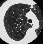 COPDのCT像