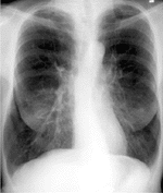 COPDの写真